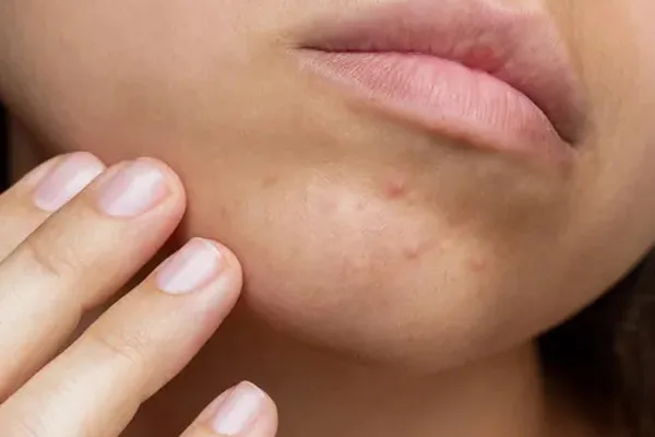 Nahaufnahme einer Frau mit unreiner Haut am Kinn